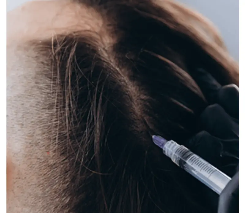 mesotherapy in Istanbul
