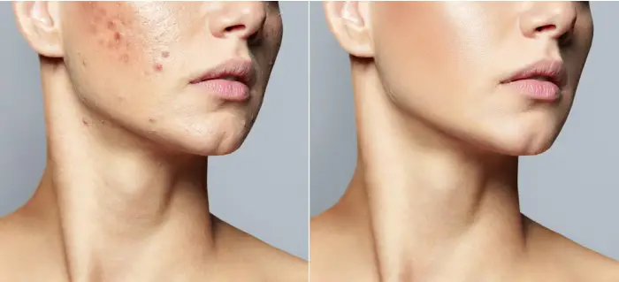 Melasma Laser Treatment: 3 Steps to Achieve Clear Skin