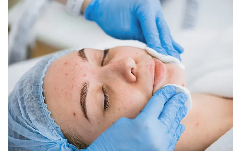How to Care for Your Skin After Melasma Laser Treatment?
