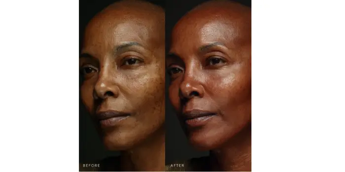 How Morpheus8 Face and Neck Treatments Transform Your Skin from Within?